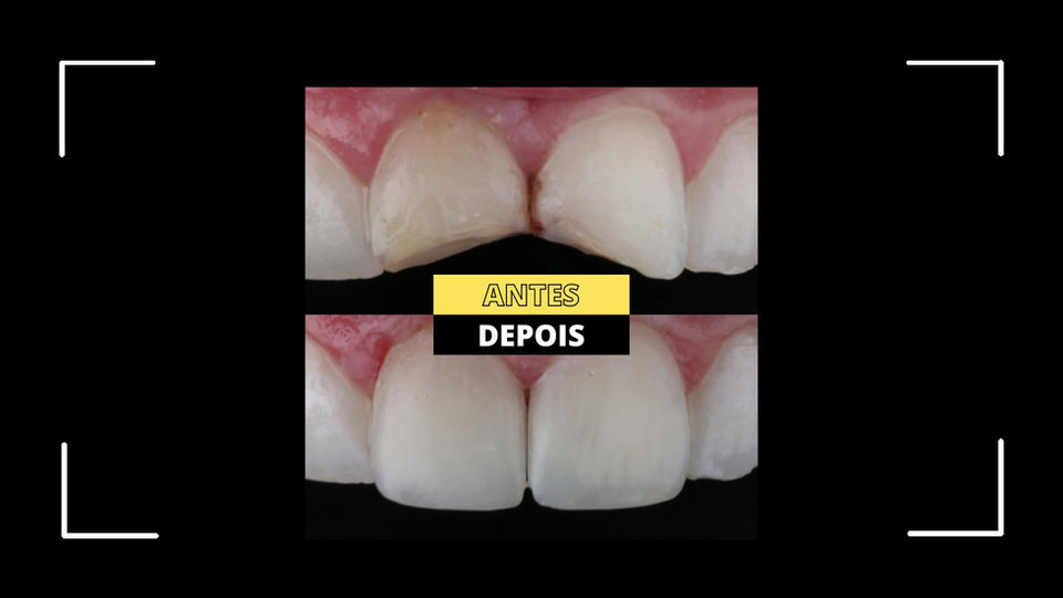 Escultura de dentes partidos